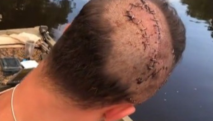 Stitches: After the serious accident, Jeffrey Heim had to sew 34 stitches in his head.  Photo: Screenshot from SHRKco LLC/Instagram.
