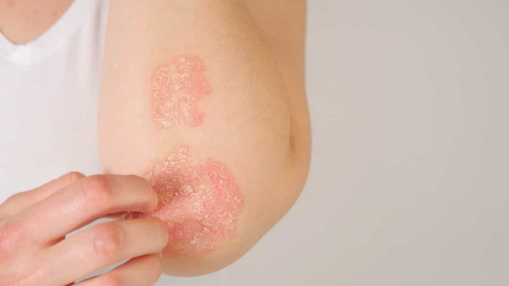 “There are definitely more than 200,000 psoriasis patients in Portugal.”