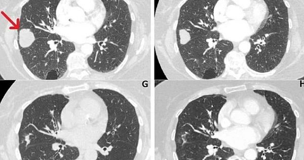 Elderly lung tumors decreased by 76% after cannabidiol use