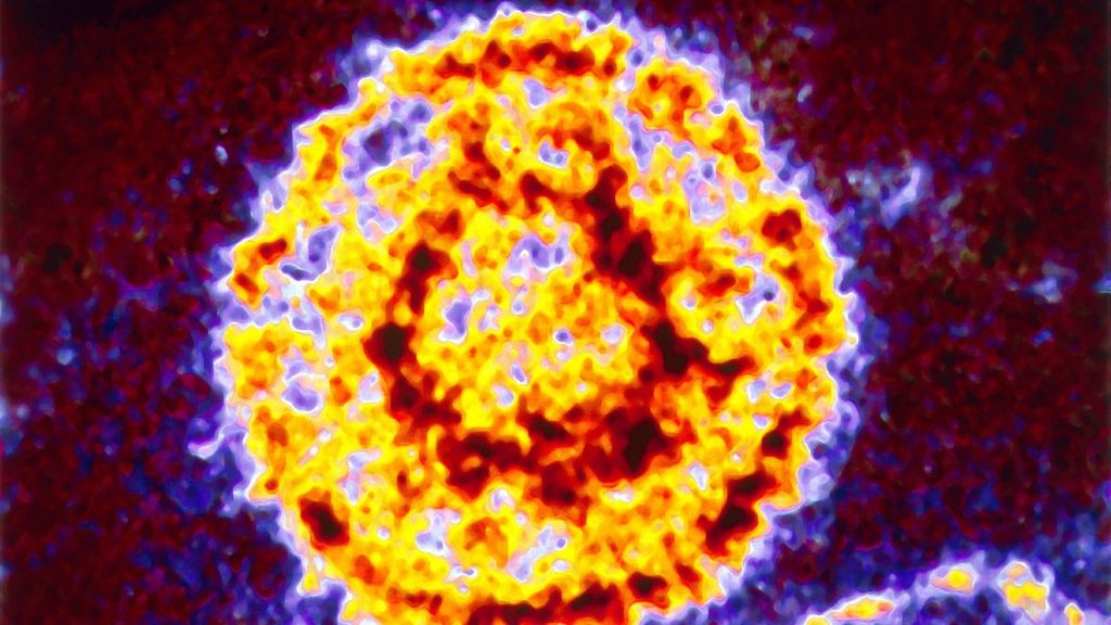 Epstein-Barr virus may cause multiple sclerosis