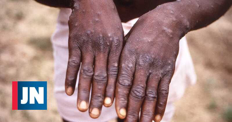 The World Health Organization acknowledges that monkeypox virus may have been circulating for months