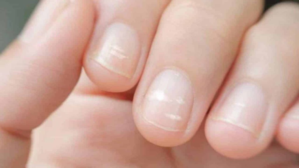 Why do white spots and lines appear on the nails?