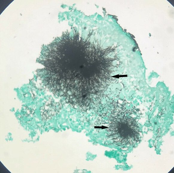 Unintended guest: The photo shows bacterial colonies that were in the 20-year-old's mouth.  Photo: Curious Journal of Medical Sciences