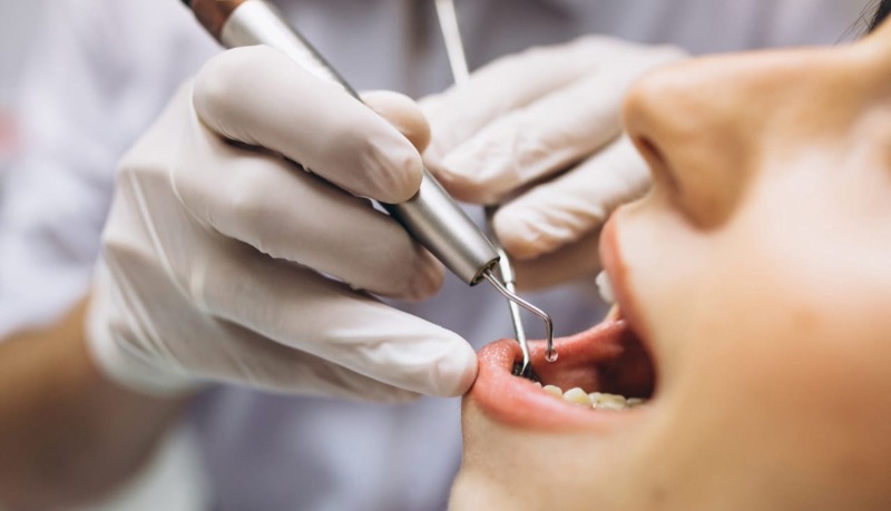 Tartar on the teeth: how to avoid it