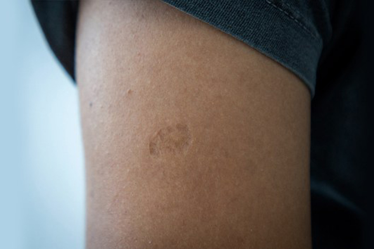 Find out why the BCG vaccine leaves a mark on the arm in most people