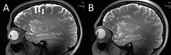 Larger: arrows on the MRI image on the left show enlarged perivascular spaces in a patient with chronic migraine.  The MRI image on the right shows the brain of a person without migraine.  Photo: RSNA/Wilson Xu