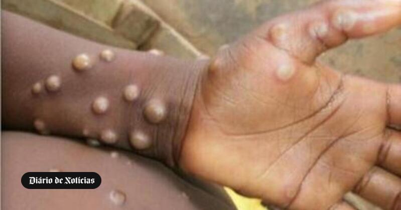 Transgender women are highly susceptible to monkeypox